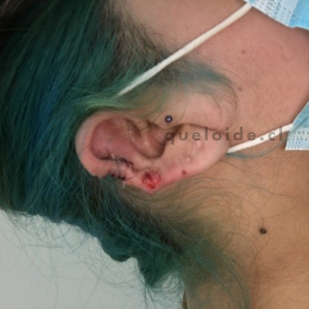 Post cirugía extracción de queloide en oreja