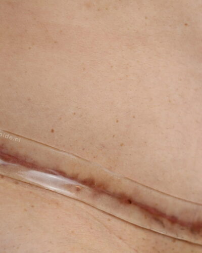 Lámina de silicona para cicatrices (Transparente) 35cm x 3cm PIURMED®